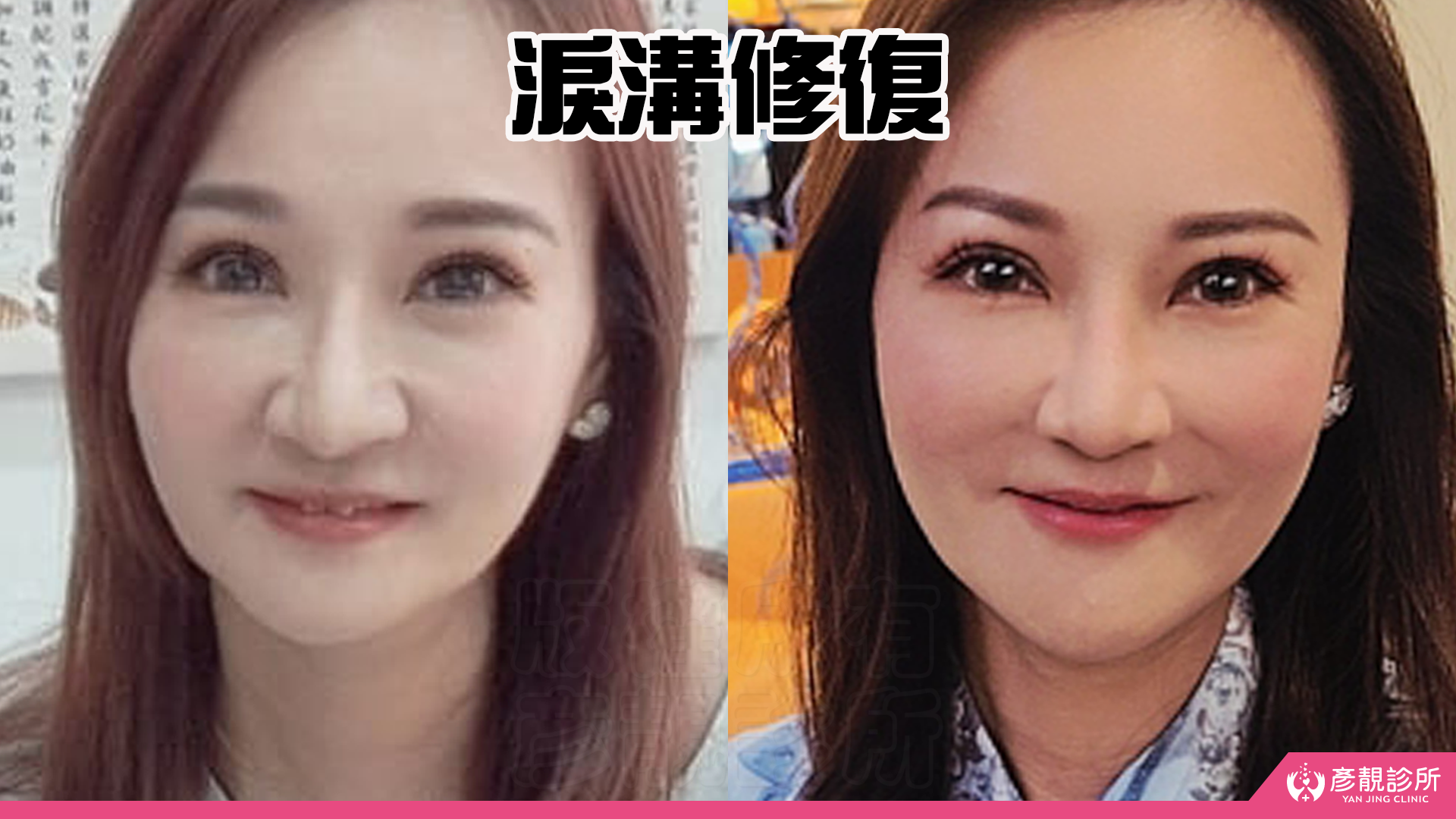 告別顯老頸紋與雞爪手!大分子玻尿酸打造高級天鵝頸與貴婦澎潤感 27 雞爪手 不動刀改善 脖紋 頸部拉提 玻尿酸 彥靚 診所 膠原蛋白 推薦 撫紋填補 價格費用 台北 桃園 新竹 頸紋 評價 黃政達 醫師 結節 凹凸不平 副作用 併發症 後遺症 心得 分享 硬塊 115061926