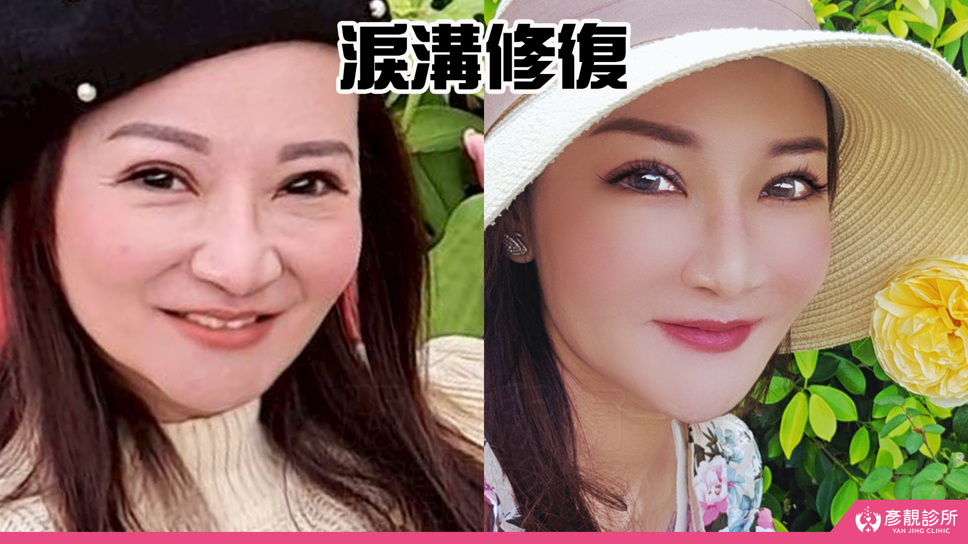 告別顯老頸紋與雞爪手!大分子玻尿酸打造高級天鵝頸與貴婦澎潤感 26 雞爪手 不動刀改善 脖紋 頸部拉提 玻尿酸 彥靚 診所 膠原蛋白 推薦 撫紋填補 價格費用 台北 桃園 新竹 頸紋 評價 黃政達 醫師 結節 凹凸不平 副作用 併發症 後遺症 心得 分享 硬塊 115061927