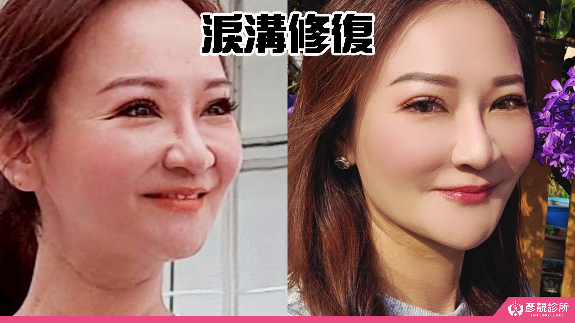 告別顯老頸紋與雞爪手!大分子玻尿酸打造高級天鵝頸與貴婦澎潤感 25 雞爪手 不動刀改善 脖紋 頸部拉提 玻尿酸 彥靚 診所 膠原蛋白 推薦 撫紋填補 價格費用 台北 桃園 新竹 頸紋 評價 黃政達 醫師 結節 凹凸不平 副作用 併發症 後遺症 心得 分享 硬塊 115061928