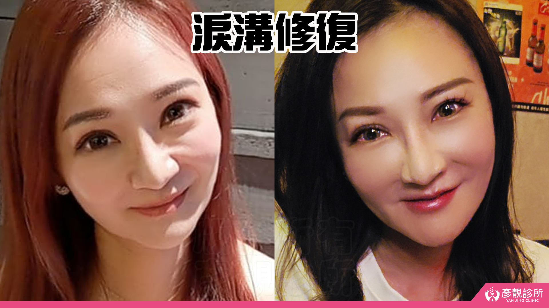 告別顯老頸紋與雞爪手!大分子玻尿酸打造高級天鵝頸與貴婦澎潤感 24 雞爪手 不動刀改善 脖紋 頸部拉提 玻尿酸 彥靚 診所 膠原蛋白 推薦 撫紋填補 價格費用 台北 桃園 新竹 頸紋 評價 黃政達 醫師 結節 凹凸不平 副作用 併發症 後遺症 心得 分享 硬塊 115061929