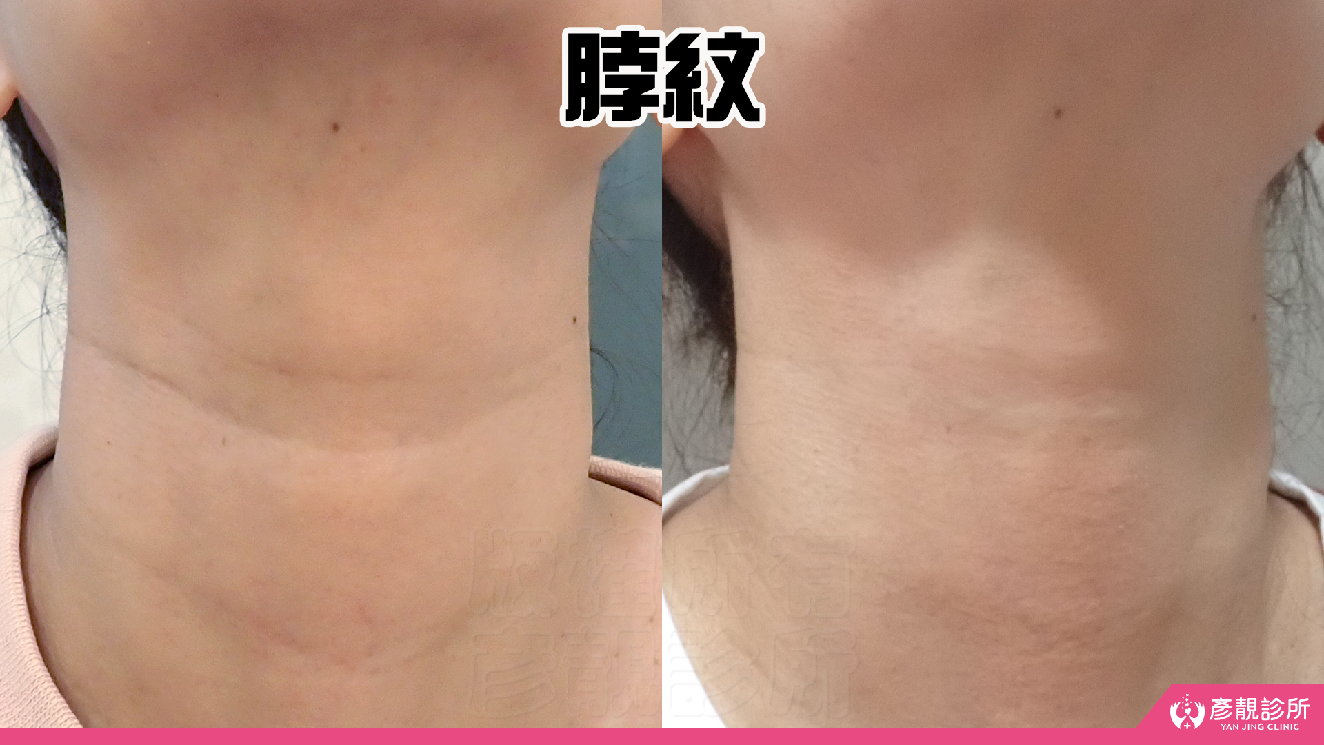 告別顯老頸紋與雞爪手!大分子玻尿酸打造高級天鵝頸與貴婦澎潤感 30 雞爪手 不動刀改善 脖紋 頸部拉提 玻尿酸 彥靚 診所 膠原蛋白 推薦 撫紋填補 價格費用 台北 桃園 新竹 頸紋 評價 黃政達 醫師 結節 凹凸不平 副作用 併發症 後遺症 心得 分享 硬塊 115061930