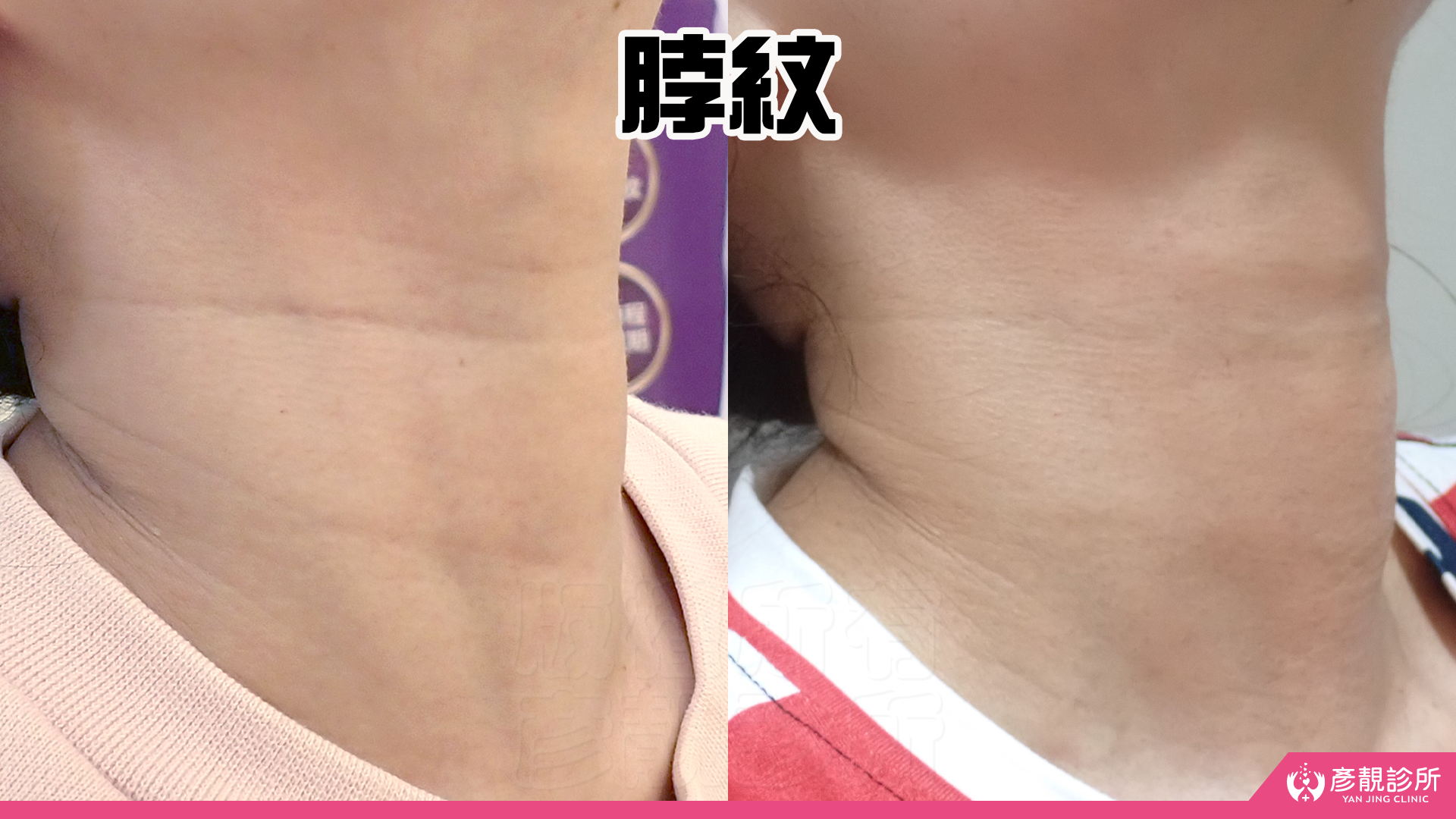 告別顯老頸紋與雞爪手!大分子玻尿酸打造高級天鵝頸與貴婦澎潤感 31 雞爪手 不動刀改善 脖紋 頸部拉提 玻尿酸 彥靚 診所 膠原蛋白 推薦 撫紋填補 價格費用 台北 桃園 新竹 頸紋 評價 黃政達 醫師 結節 凹凸不平 副作用 併發症 後遺症 心得 分享 硬塊 115061931