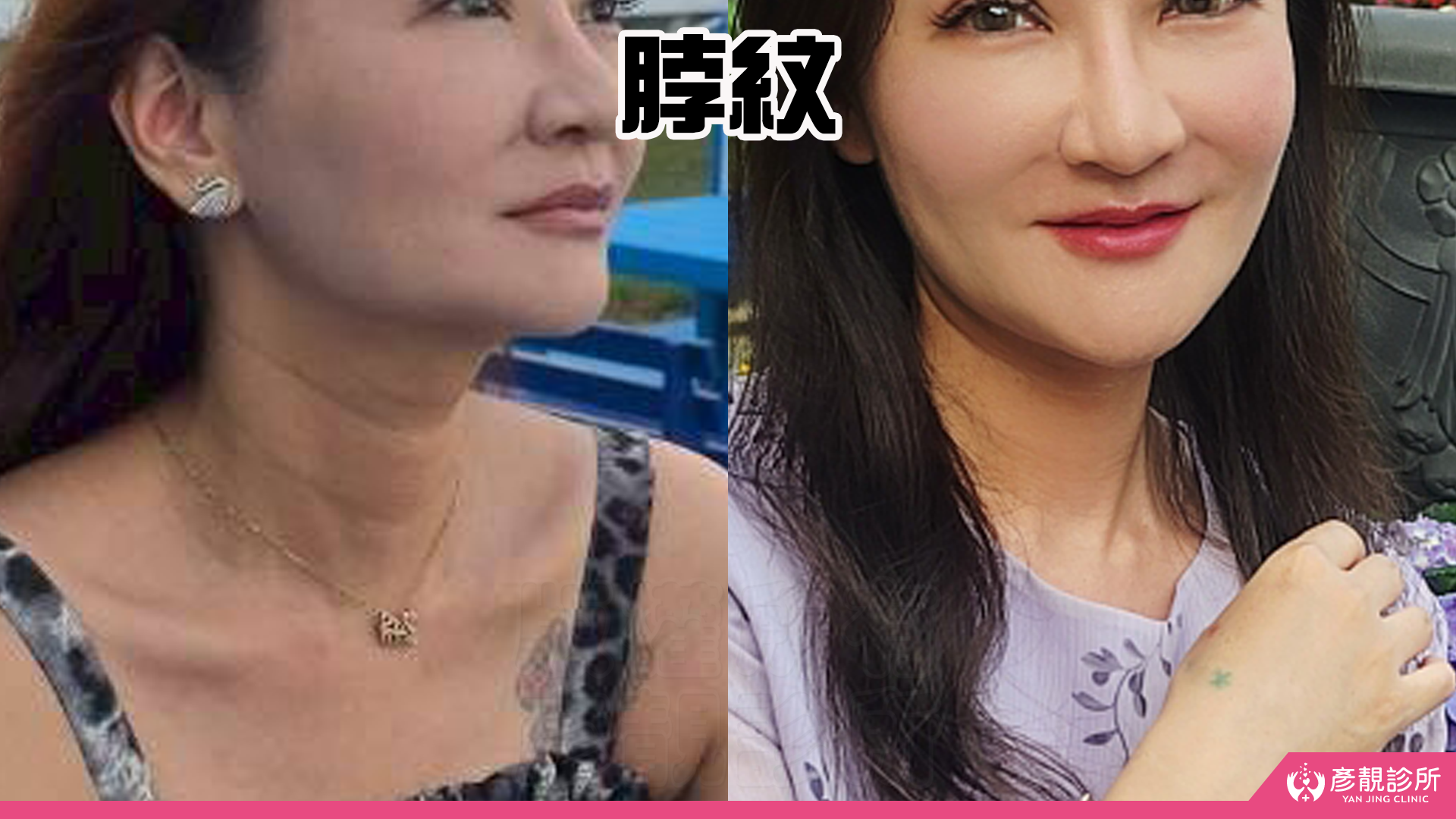 告別顯老頸紋與雞爪手!大分子玻尿酸打造高級天鵝頸與貴婦澎潤感 37 雞爪手 不動刀改善 脖紋 頸部拉提 玻尿酸 彥靚 診所 膠原蛋白 推薦 撫紋填補 價格費用 台北 桃園 新竹 頸紋 評價 黃政達 醫師 結節 凹凸不平 副作用 併發症 後遺症 心得 分享 硬塊 115061932