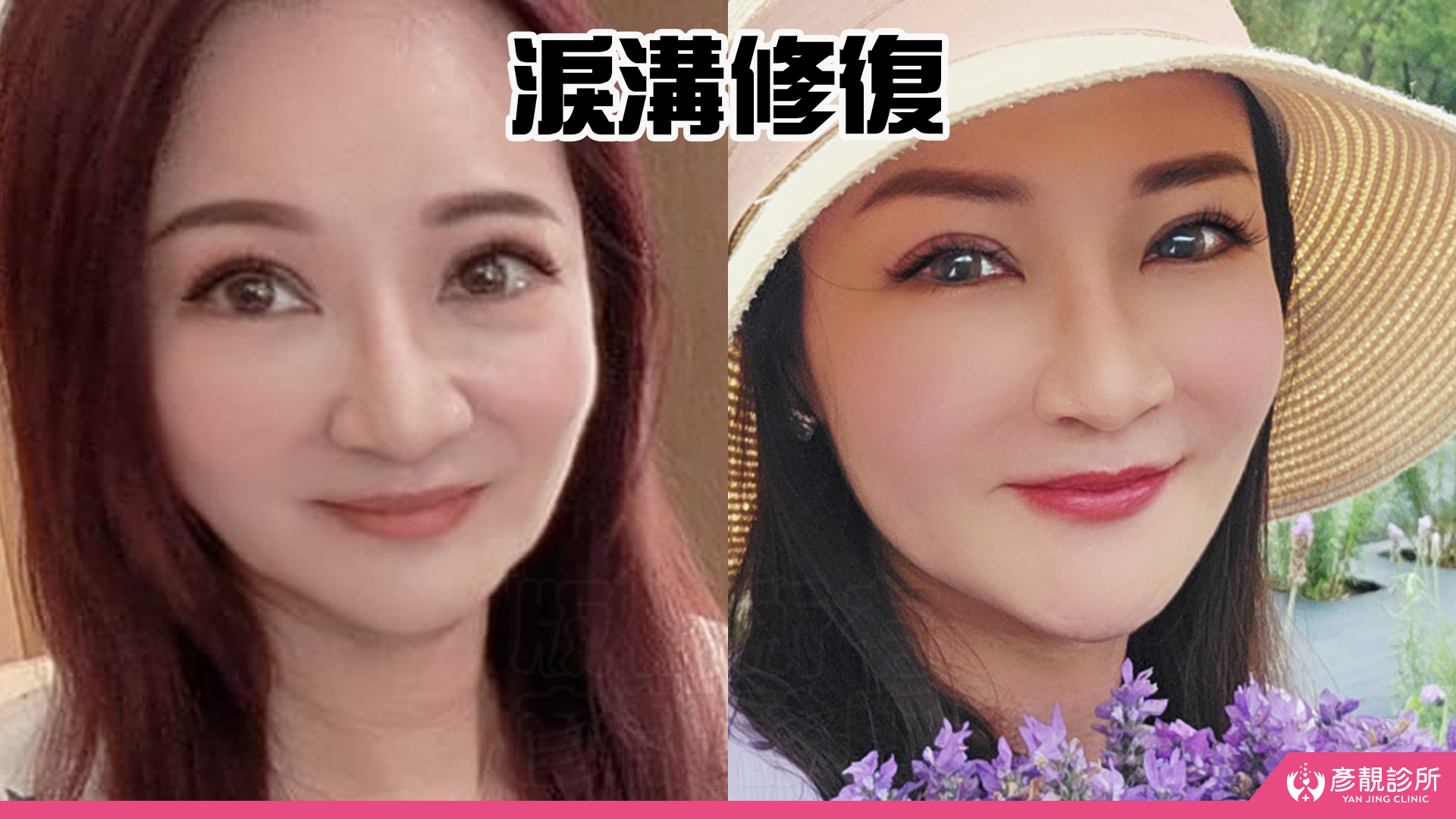 告別顯老頸紋與雞爪手!大分子玻尿酸打造高級天鵝頸與貴婦澎潤感 23 雞爪手 不動刀改善 脖紋 頸部拉提 玻尿酸 彥靚 診所 膠原蛋白 推薦 撫紋填補 價格費用 台北 桃園 新竹 頸紋 評價 黃政達 醫師 結節 凹凸不平 副作用 併發症 後遺症 心得 分享 硬塊 115061933