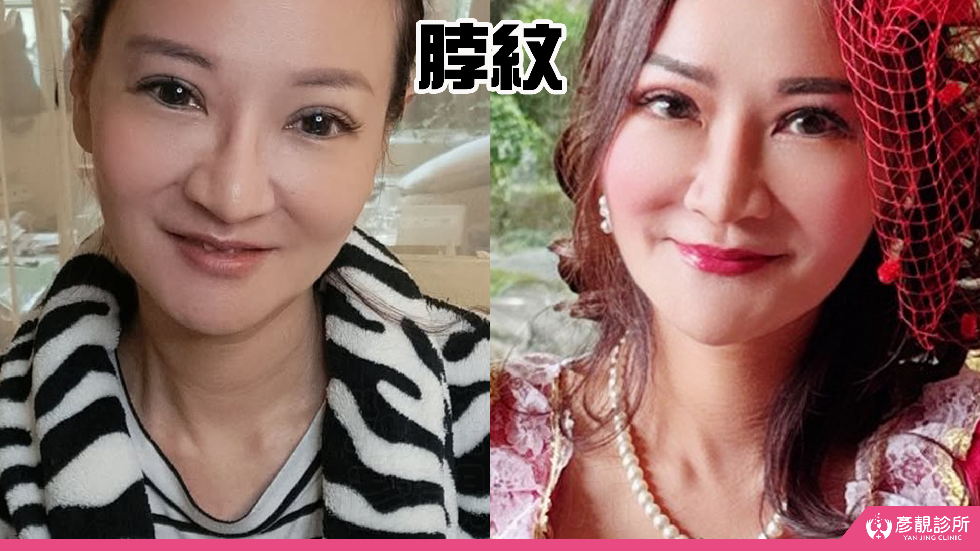 告別顯老頸紋與雞爪手!大分子玻尿酸打造高級天鵝頸與貴婦澎潤感 36 雞爪手 不動刀改善 脖紋 頸部拉提 玻尿酸 彥靚 診所 膠原蛋白 推薦 撫紋填補 價格費用 台北 桃園 新竹 頸紋 評價 黃政達 醫師 結節 凹凸不平 副作用 併發症 後遺症 心得 分享 硬塊 115061934