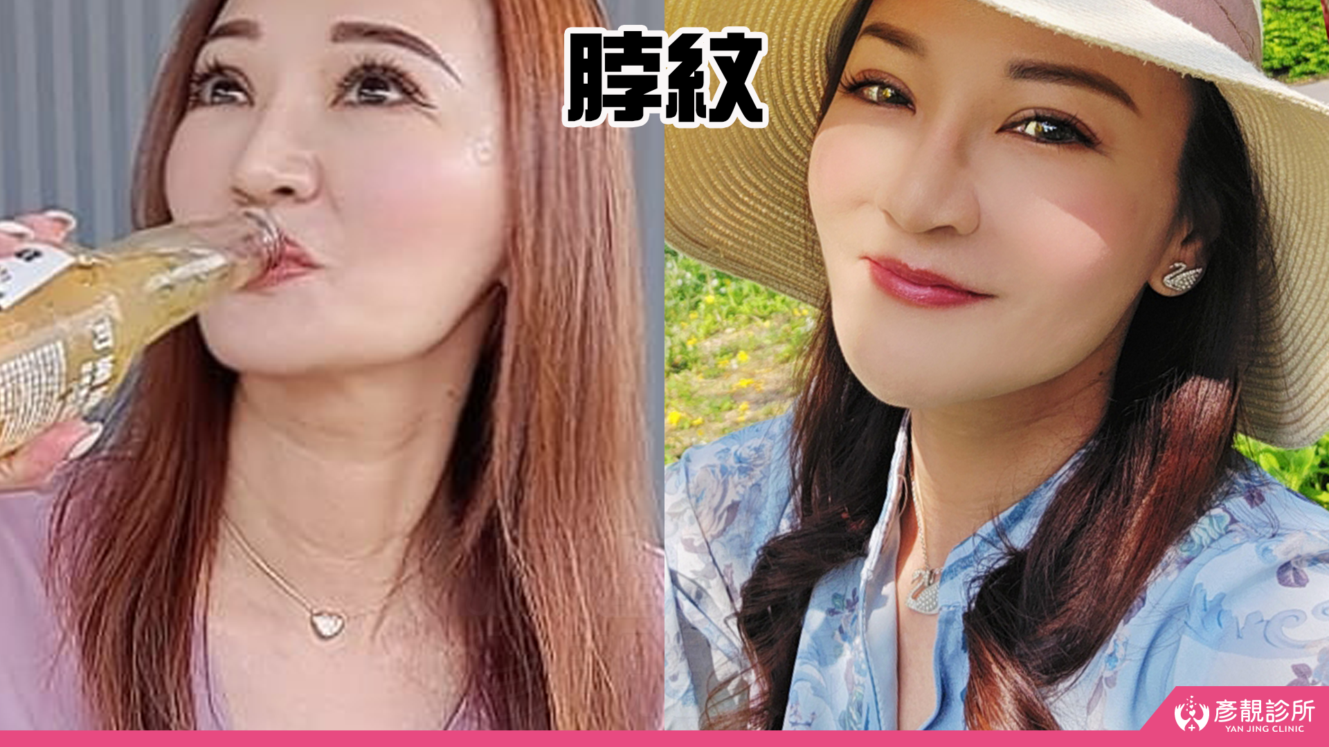 告別顯老頸紋與雞爪手!大分子玻尿酸打造高級天鵝頸與貴婦澎潤感 35 雞爪手 不動刀改善 脖紋 頸部拉提 玻尿酸 彥靚 診所 膠原蛋白 推薦 撫紋填補 價格費用 台北 桃園 新竹 頸紋 評價 黃政達 醫師 結節 凹凸不平 副作用 併發症 後遺症 心得 分享 硬塊 115061935