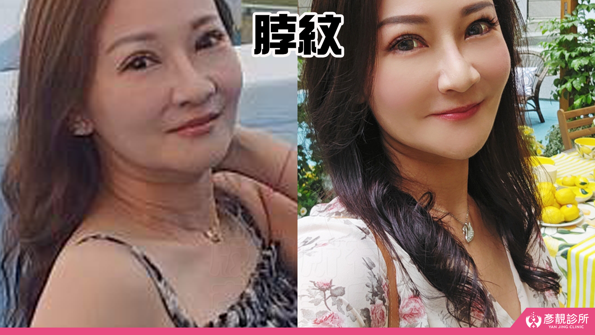 告別顯老頸紋與雞爪手!大分子玻尿酸打造高級天鵝頸與貴婦澎潤感 34 雞爪手 不動刀改善 脖紋 頸部拉提 玻尿酸 彥靚 診所 膠原蛋白 推薦 撫紋填補 價格費用 台北 桃園 新竹 頸紋 評價 黃政達 醫師 結節 凹凸不平 副作用 併發症 後遺症 心得 分享 硬塊 115061937