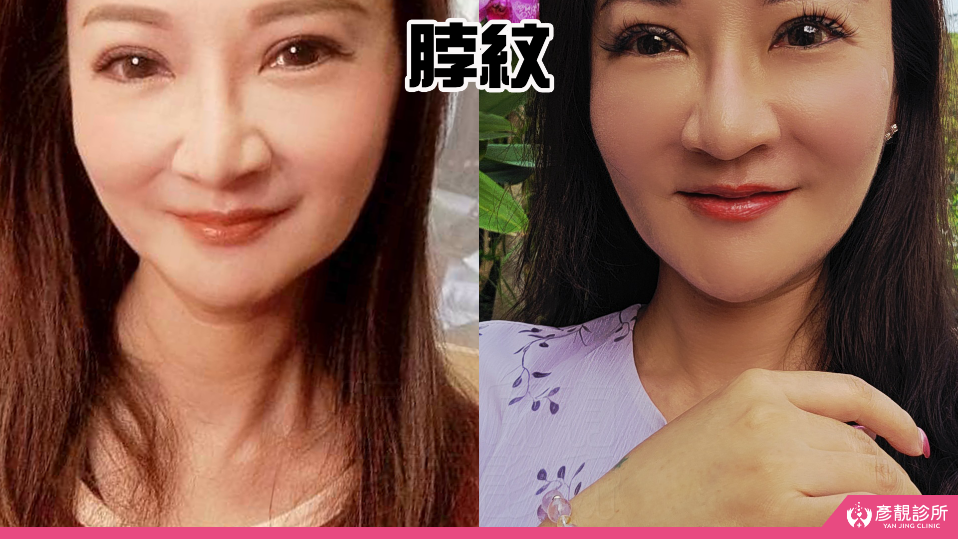 告別顯老頸紋與雞爪手!大分子玻尿酸打造高級天鵝頸與貴婦澎潤感 33 雞爪手 不動刀改善 脖紋 頸部拉提 玻尿酸 彥靚 診所 膠原蛋白 推薦 撫紋填補 價格費用 台北 桃園 新竹 頸紋 評價 黃政達 醫師 結節 凹凸不平 副作用 併發症 後遺症 心得 分享 硬塊 115061938