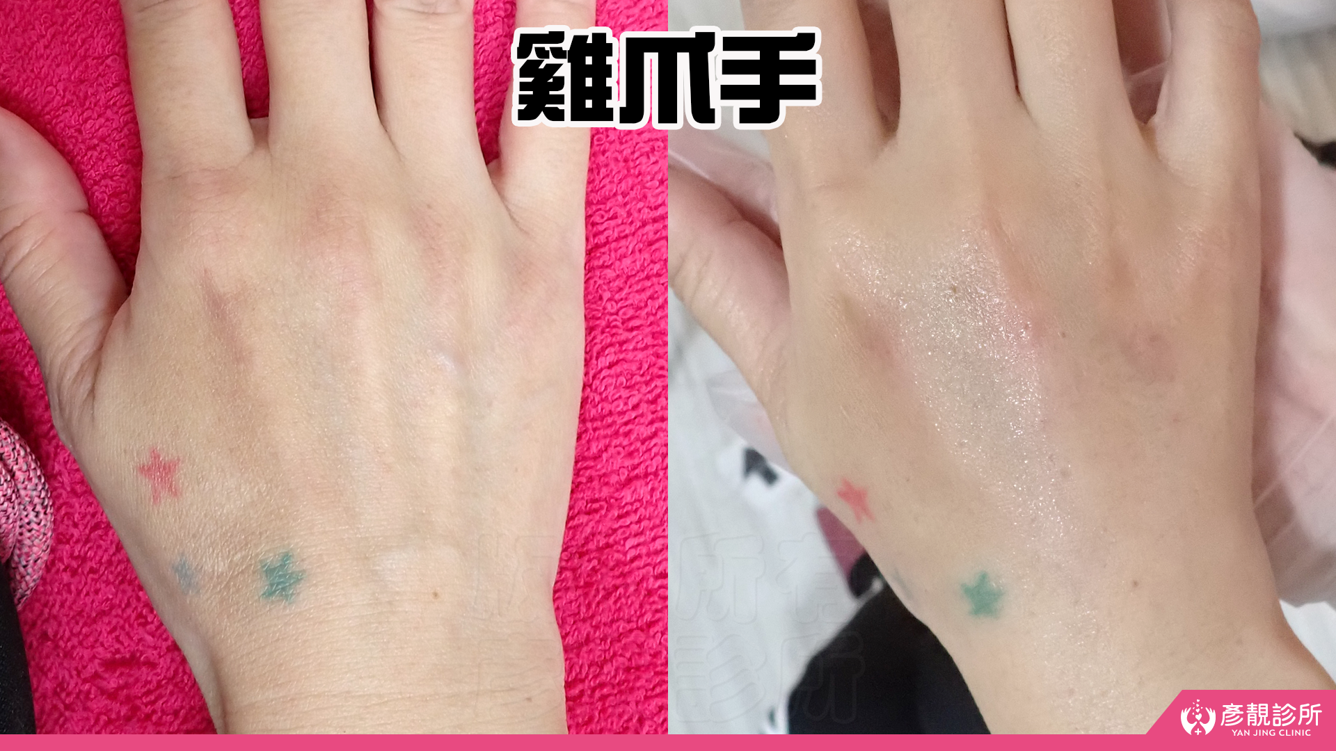 告別顯老頸紋與雞爪手!大分子玻尿酸打造高級天鵝頸與貴婦澎潤感 38 雞爪手 不動刀改善 脖紋 頸部拉提 玻尿酸 彥靚 診所 膠原蛋白 推薦 撫紋填補 價格費用 台北 桃園 新竹 頸紋 評價 黃政達 醫師 結節 凹凸不平 副作用 併發症 後遺症 心得 分享 硬塊 115061941