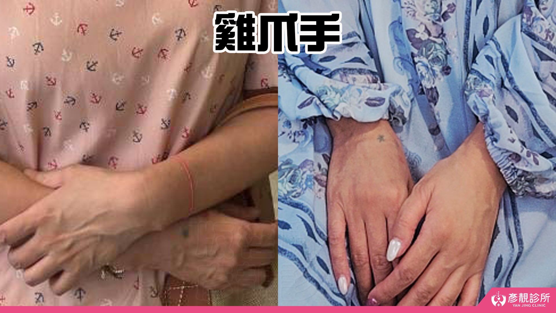 告別顯老頸紋與雞爪手!大分子玻尿酸打造高級天鵝頸與貴婦澎潤感 41 雞爪手 不動刀改善 脖紋 頸部拉提 玻尿酸 彥靚 診所 膠原蛋白 推薦 撫紋填補 價格費用 台北 桃園 新竹 頸紋 評價 黃政達 醫師 結節 凹凸不平 副作用 併發症 後遺症 心得 分享 硬塊 115061943