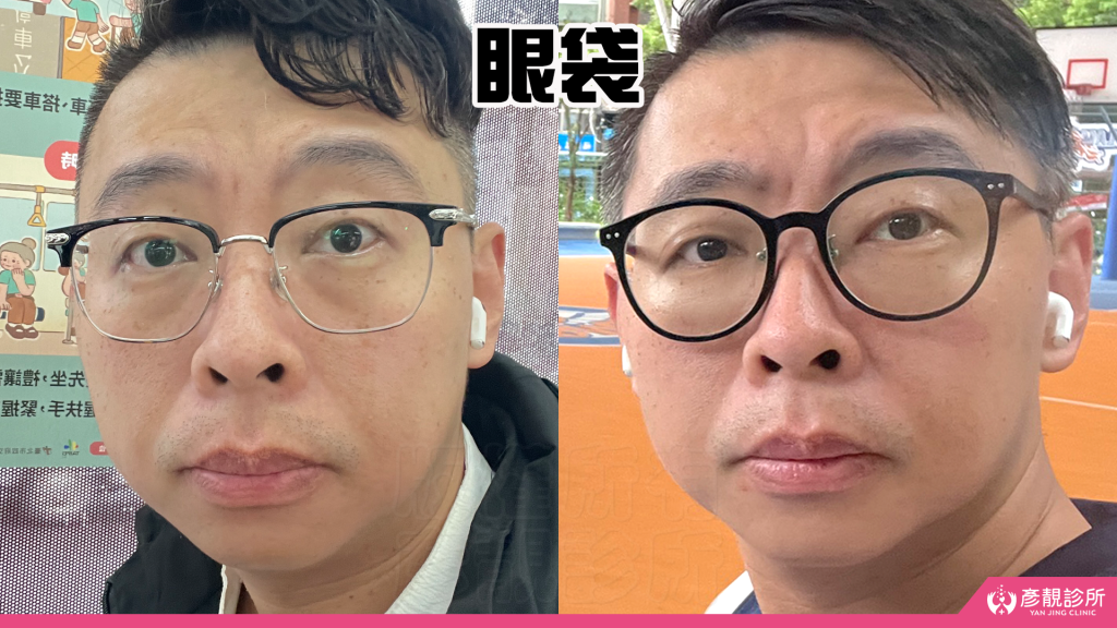 彥靚診所玻尿酸消除眼袋心得|醫美小白初體驗!自然改善眼袋與疲憊感,不用手術也能改善眼袋?醫師技術、護理服務完整分享 24 Anti Wrinkle Treatment Frown Lines Price