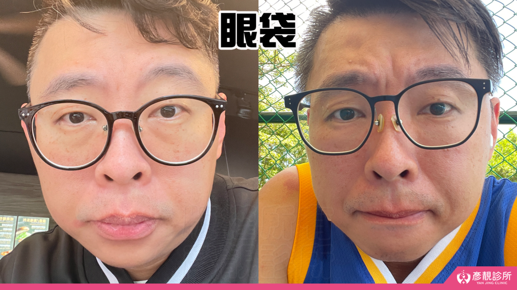 彥靚診所玻尿酸消除眼袋心得|醫美小白初體驗!自然改善眼袋與疲憊感,不用手術也能改善眼袋?醫師技術、護理服務完整分享 23 Dark Circle Injection Dark Circles Cost