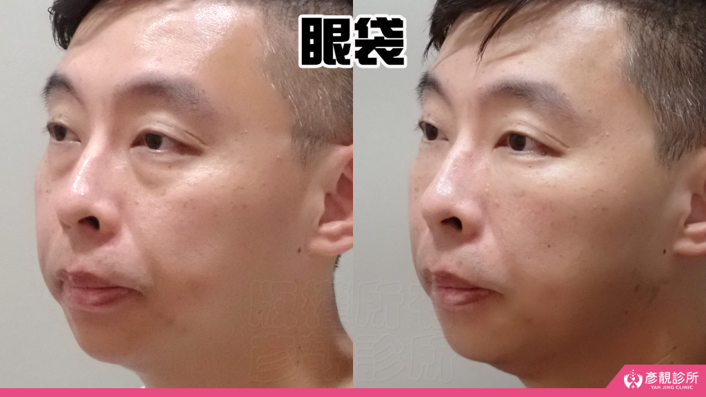 彥靚診所玻尿酸消除眼袋心得|醫美小白初體驗!自然改善眼袋與疲憊感,不用手術也能改善眼袋?醫師技術、護理服務完整分享 22 Dcard Botox Before and After Results