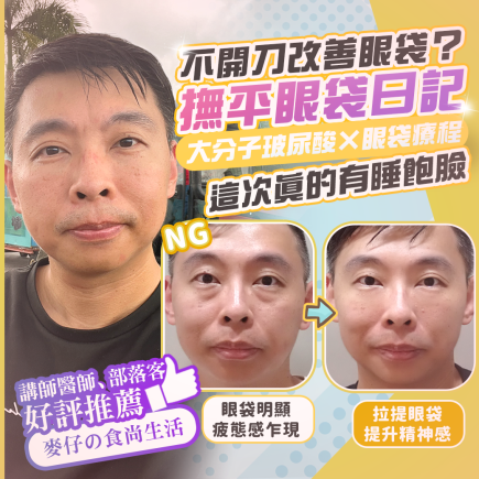 彥靚診所玻尿酸消除眼袋心得|醫美小白初體驗!自然改善眼袋與疲憊感,不用手術也能改善眼袋?醫師技術、護理服務完整分享 1 Hsinchu Hyaluronic Acid Facial Rejuvenation