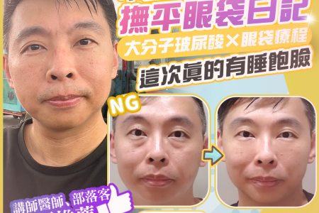 直式社群圖卡，主題為不開刀改善眼袋與徒手眼周支撐。 4D 無痕筋膜提升以支撐方向改善眼袋與淚溝高低差，同時保留眼周自然轉折。