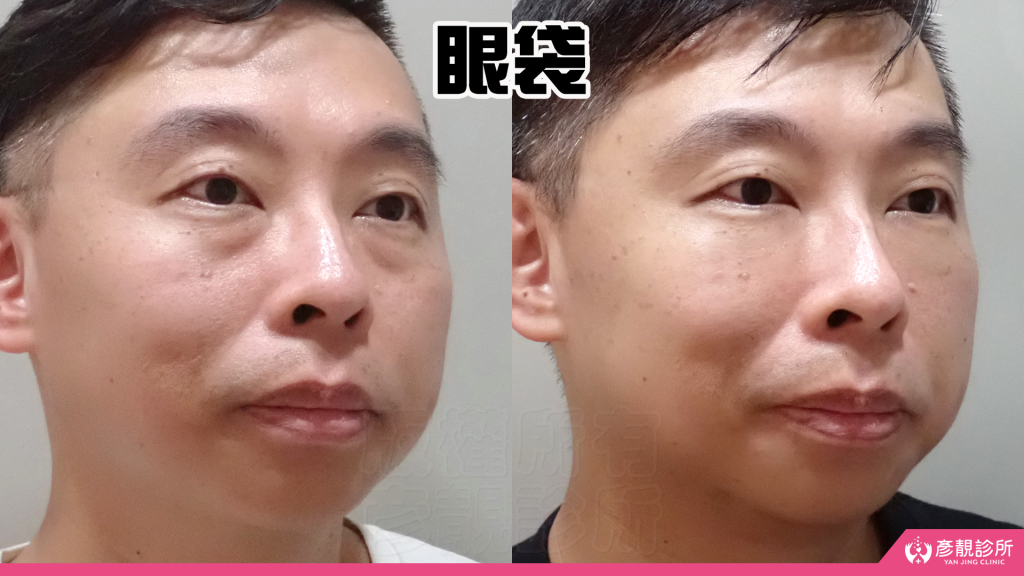 彥靚診所玻尿酸消除眼袋心得|醫美小白初體驗!自然改善眼袋與疲憊感,不用手術也能改善眼袋?醫師技術、護理服務完整分享 19 Hyaluronic Acid Nasolabial Folds Before and After