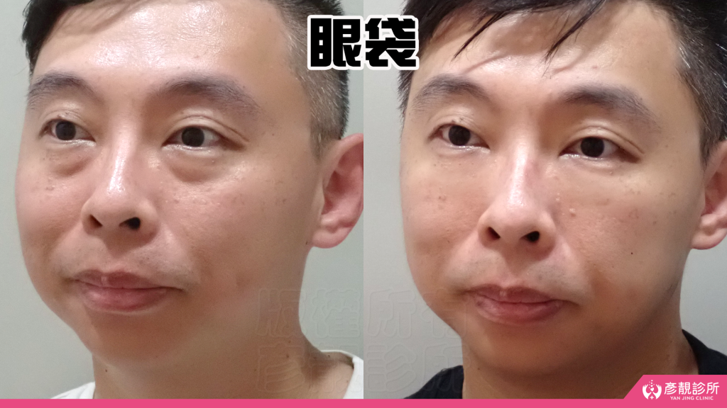 彥靚診所玻尿酸消除眼袋心得|醫美小白初體驗!自然改善眼袋與疲憊感,不用手術也能改善眼袋?醫師技術、護理服務完整分享 20 Hyaluronic Acid Tear Trough Under Eye Bags