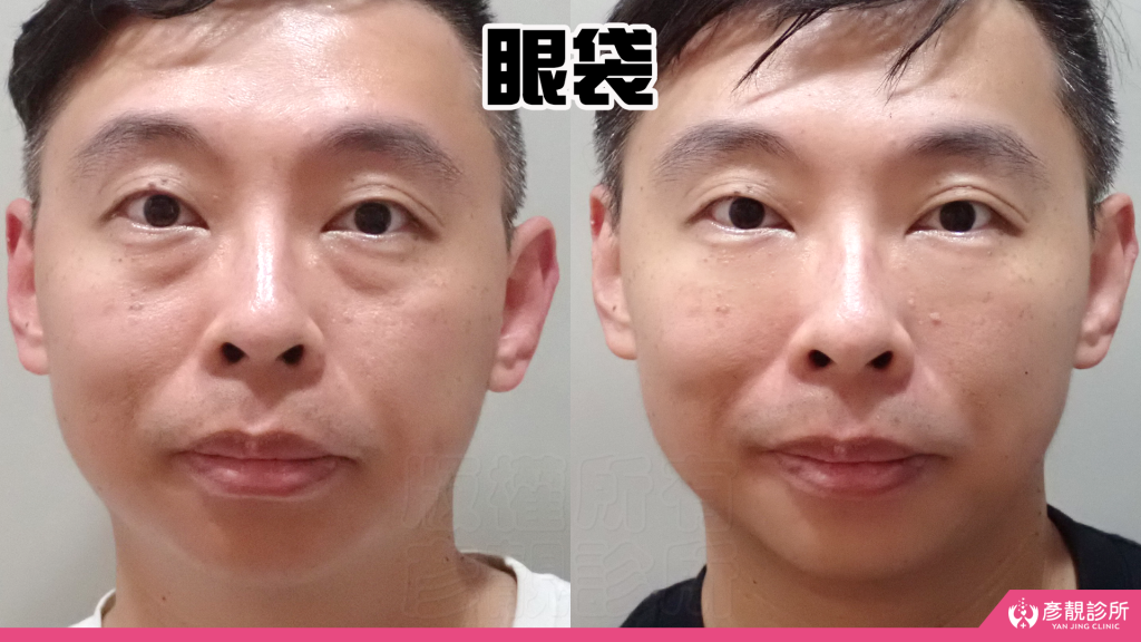 彥靚診所玻尿酸消除眼袋心得|醫美小白初體驗!自然改善眼袋與疲憊感,不用手術也能改善眼袋?醫師技術、護理服務完整分享 17 Jawline Contouring Chin Augmentation Cost