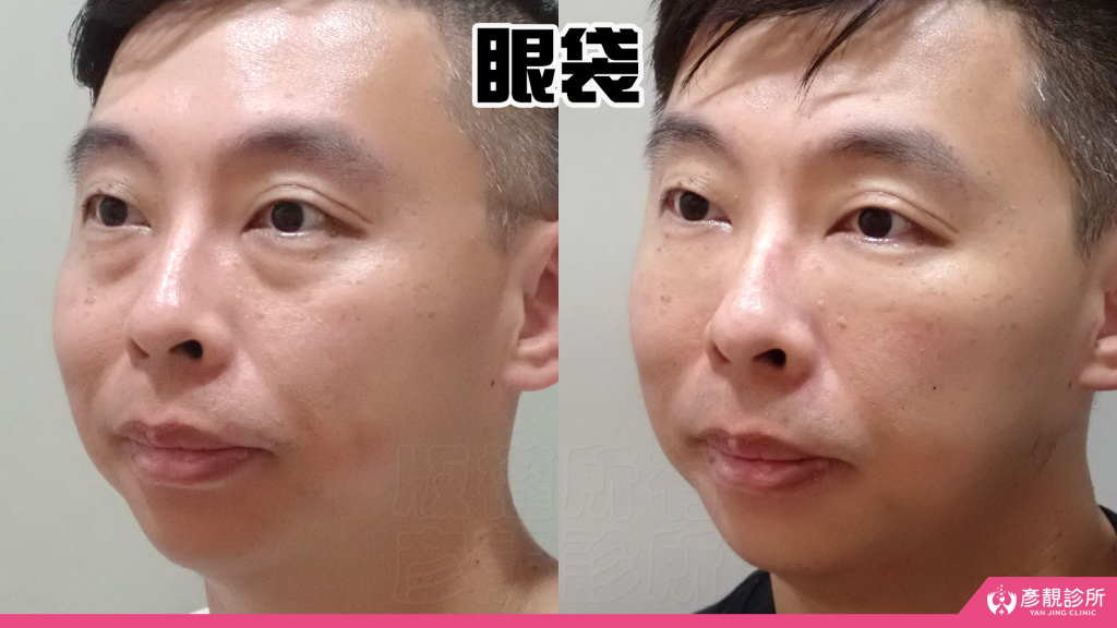 彥靚診所玻尿酸消除眼袋心得|醫美小白初體驗!自然改善眼袋與疲憊感,不用手術也能改善眼袋?醫師技術、護理服務完整分享 21 Marionette Lines Nasolabial Folds Hyaluronic Acid