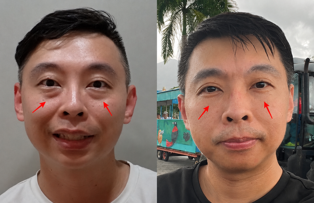 彥靚診所玻尿酸消除眼袋心得|醫美小白初體驗!自然改善眼袋與疲憊感,不用手術也能改善眼袋?醫師技術、護理服務完整分享 14 Taoyuan Taipei Hsinchu