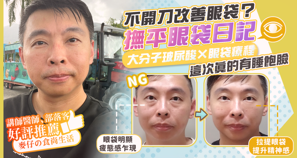 彥靚診所玻尿酸消除眼袋心得|醫美小白初體驗!自然改善眼袋與疲憊感,不用手術也能改善眼袋?醫師技術、護理服務完整分享 1 Wrinkles Anti Wrinkle Treatment Botox Cost