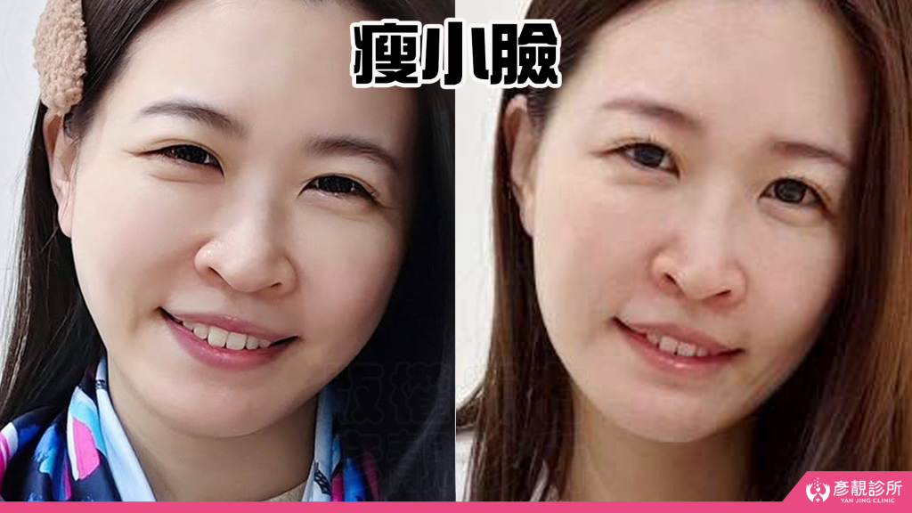 終於去處理我的咀嚼肌了!肉毒瘦小臉給我自信好上相 真實心得分享文 38 botox consultation