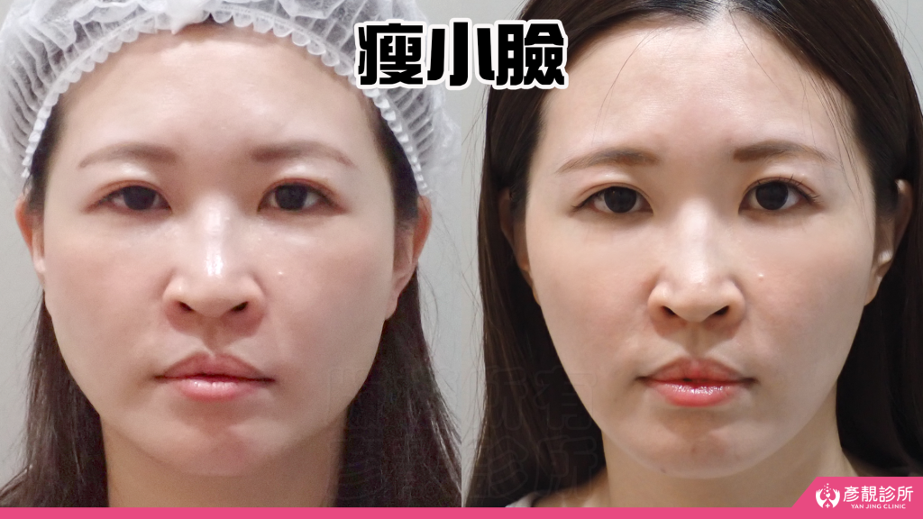 終於去處理我的咀嚼肌了!肉毒瘦小臉給我自信好上相 真實心得分享文 28 botox cost hsinchu