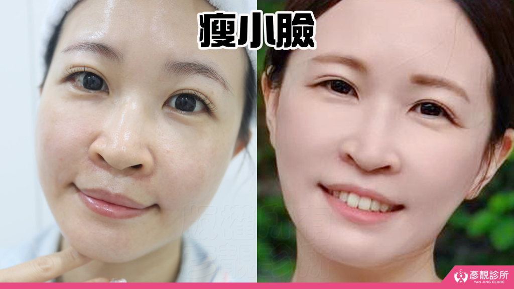 終於去處理我的咀嚼肌了!肉毒瘦小臉給我自信好上相 真實心得分享文 34 botox for masseter