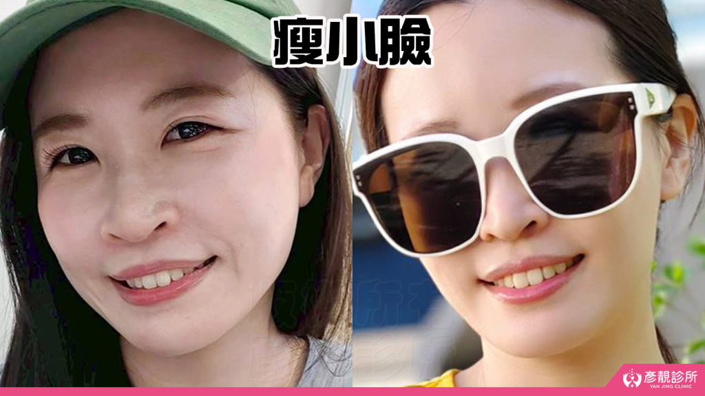 終於去處理我的咀嚼肌了!肉毒瘦小臉給我自信好上相 真實心得分享文 35 botox price