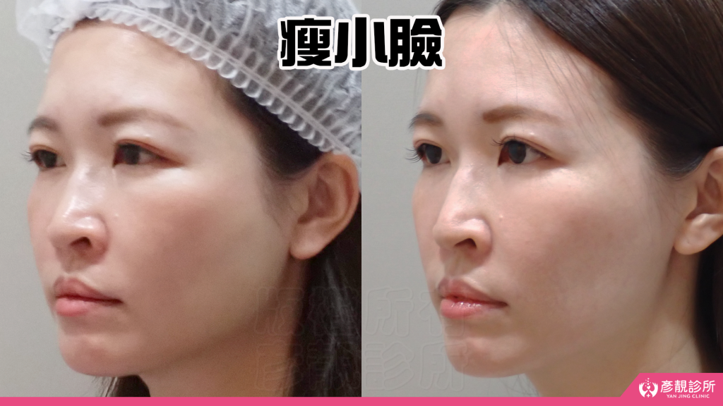 終於去處理我的咀嚼肌了!肉毒瘦小臉給我自信好上相 真實心得分享文 33 face slimming botox