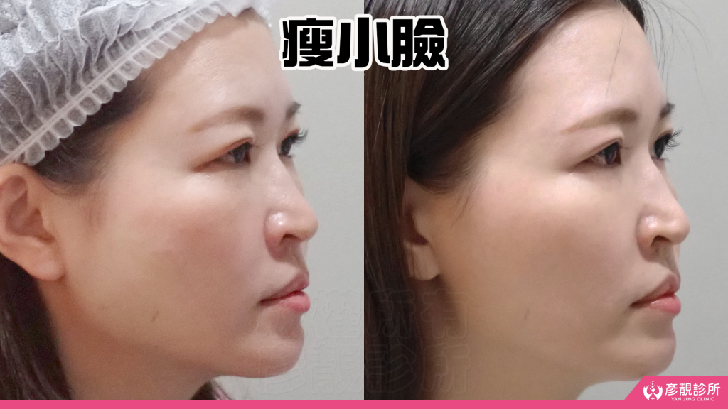 終於去處理我的咀嚼肌了!肉毒瘦小臉給我自信好上相 真實心得分享文 31 masseter botox