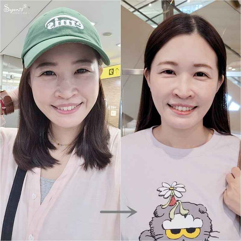 終於去處理我的咀嚼肌了!肉毒瘦小臉給我自信好上相 真實心得分享文 24 masseter botox treatment