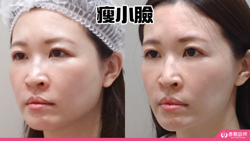 終於去處理我的咀嚼肌了!肉毒瘦小臉給我自信好上相 真實心得分享文 32 non surgical face lift