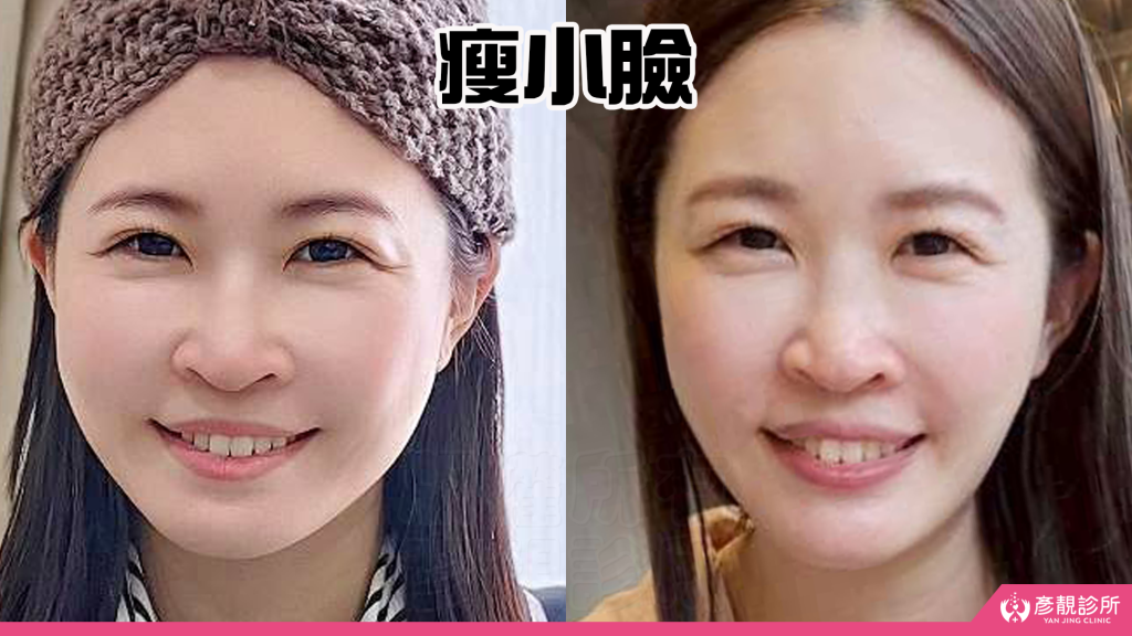 終於去處理我的咀嚼肌了!肉毒瘦小臉給我自信好上相 真實心得分享文 36 taipei botox aftercare