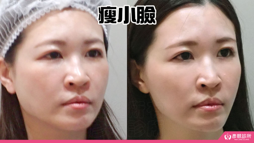 終於去處理我的咀嚼肌了!肉毒瘦小臉給我自信好上相 真實心得分享文 29 v line botox