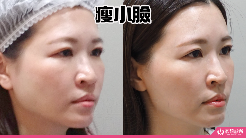 終於去處理我的咀嚼肌了!肉毒瘦小臉給我自信好上相 真實心得分享文 30 yanjing face tightening