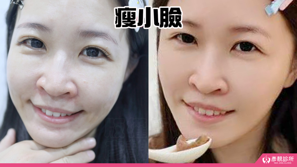 終於去處理我的咀嚼肌了!肉毒瘦小臉給我自信好上相 真實心得分享文 37 yanjing facial contouring