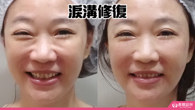 淚溝修復修 01 1024x576