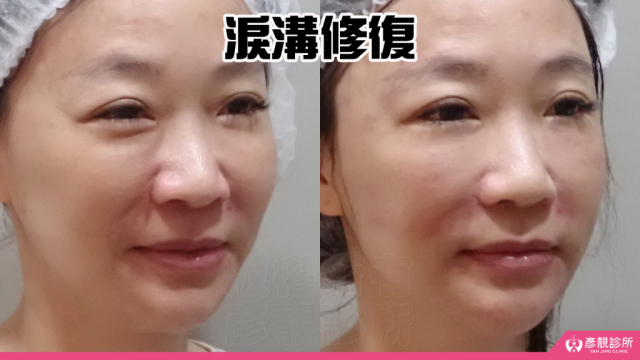 淚溝修復修 03 1024x576