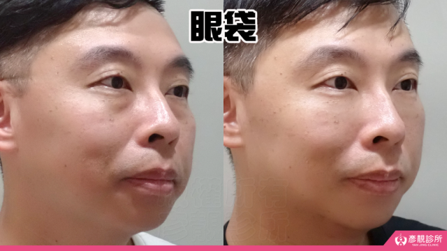 大分子玻尿酸淚溝／眼袋案例；此圖聚焦於淚溝陰影與結構型黑眼圈暗度。療程後眼下高低差縮小，蘋果肌上緣銜接更自然，外觀更平順但不追求完全無凹凸；局部與全臉比例一致。