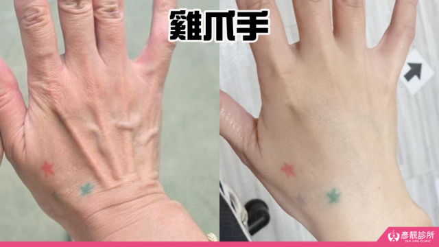 雞爪手 1 1024x576