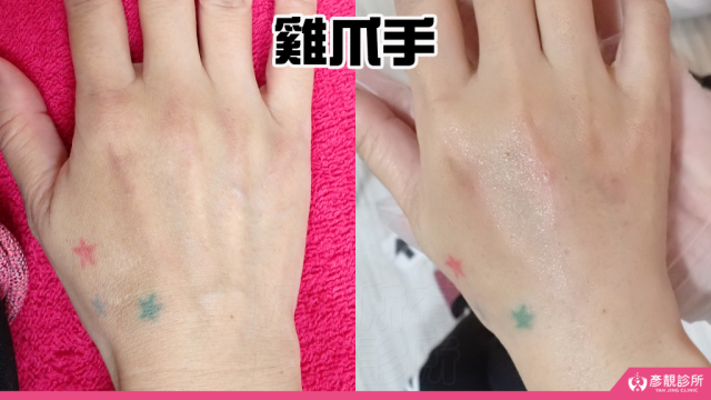 雞爪手 1024x576