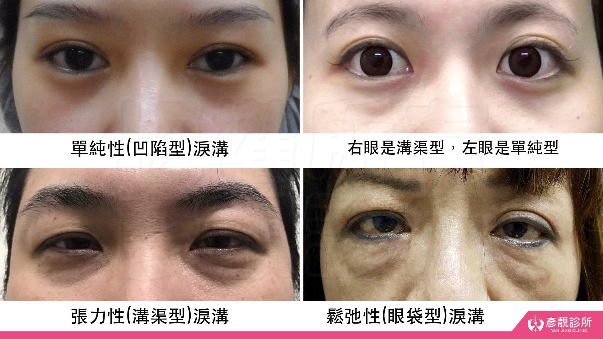 淚溝怎麼改善?先辨黑眼圈成因,再選適合的療程 11 黑眼圈分類段落的四格淚溝照片,左上為單純型、左下為溝渠型、右下為眼袋型,右上展示同一張臉雙眼分型不同;透過眼袋隆起、下方凹陷與陰影的差異,協助理解治療不能只套用單一填補方式。