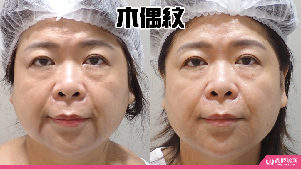 【台北醫美評價】台北彥靚診所|松江南京站:4D無痕筋膜提升 打造精緻V線!擺脫木偶紋雕塑輪廓線真實心得 19 facial contour lifting