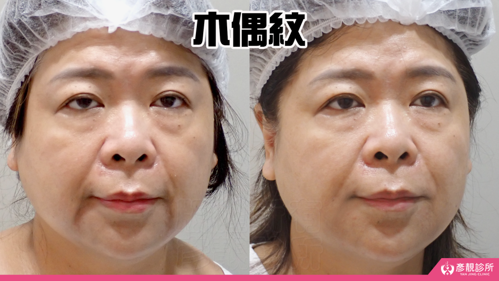 【台北醫美評價】台北彥靚診所|松江南京站:4D無痕筋膜提升 打造精緻V線!擺脫木偶紋雕塑輪廓線真實心得 20 fascia lifting treatment