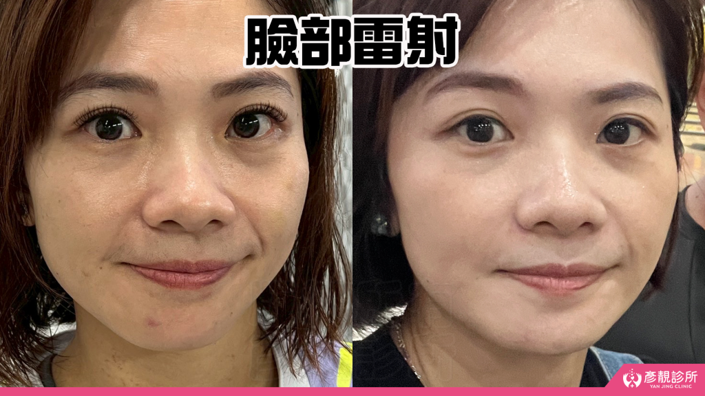 40歲後肌膚真的可以變好嗎?我的蜂巢皮秒雷射斑點改善完整紀錄分享|彥靚診所 46 freckle laser treatment
