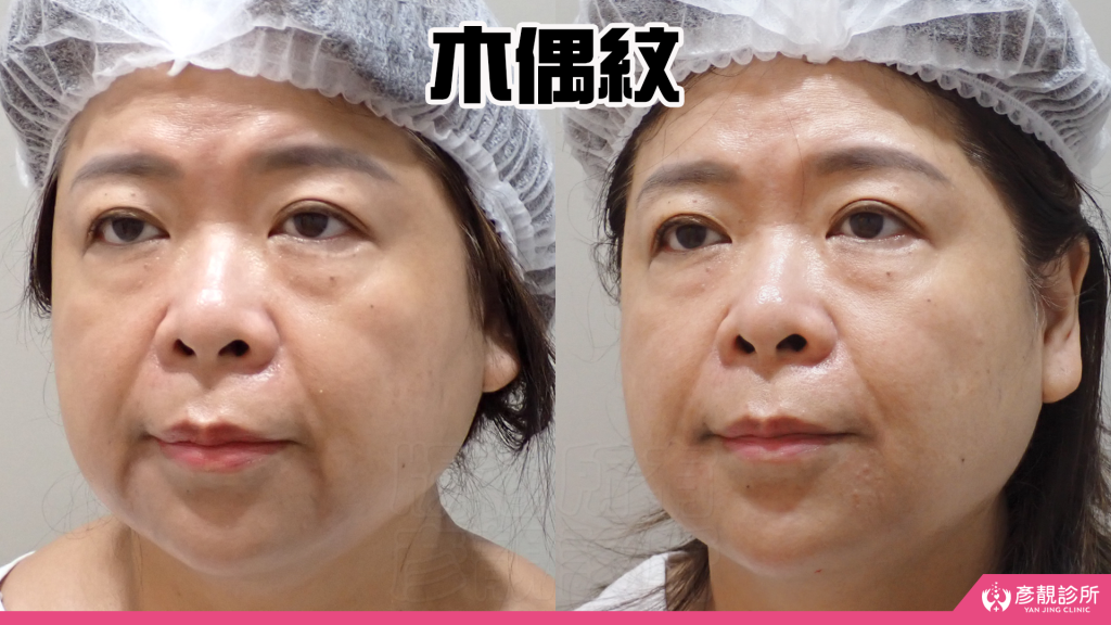 【台北醫美評價】台北彥靚診所|松江南京站:4D無痕筋膜提升 打造精緻V線!擺脫木偶紋雕塑輪廓線真實心得 22 huang zheng da filler