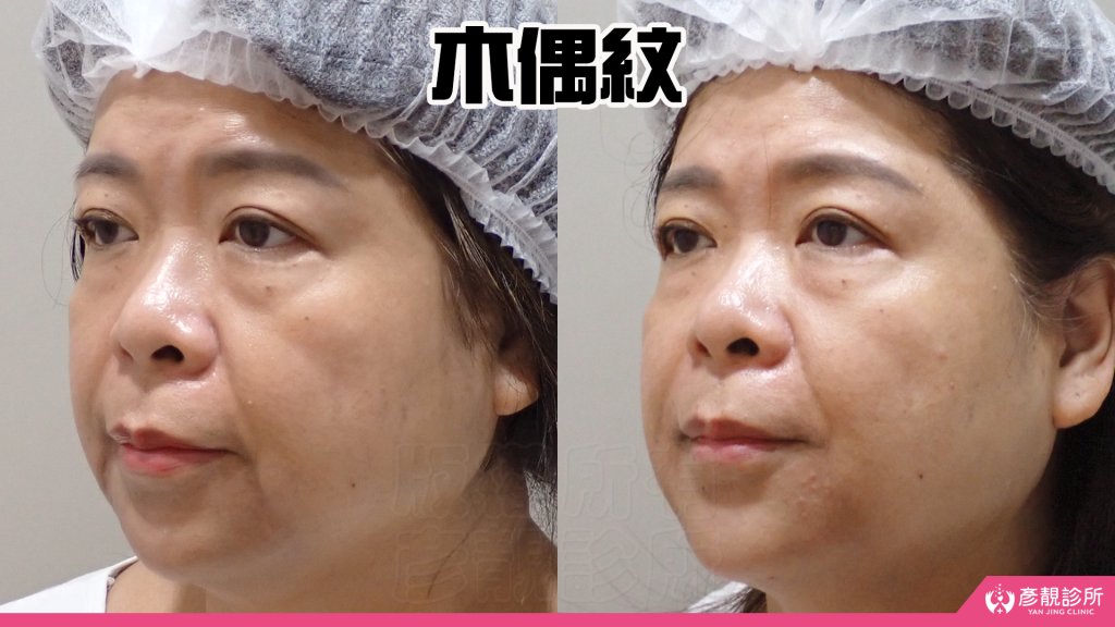 【台北醫美評價】台北彥靚診所|松江南京站:4D無痕筋膜提升 打造精緻V線!擺脫木偶紋雕塑輪廓線真實心得 23 hyaluronic acid jawline filler