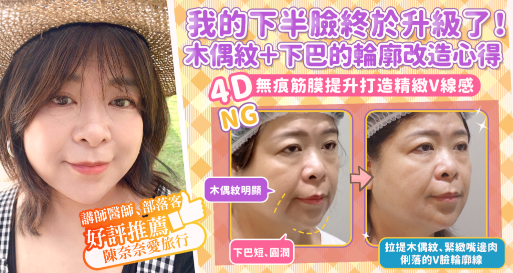 marionette line treatment