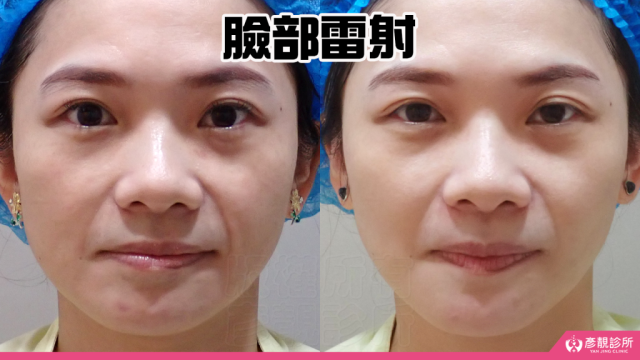 女性蜂巢皮秒雷射前後的正面臉部對照，右圖兩頰、鼻側與顴骨周圍的紅色及深色色素點較不明顯，整體膚色更一致；療程結果來自半年內多次評估與分區處理
